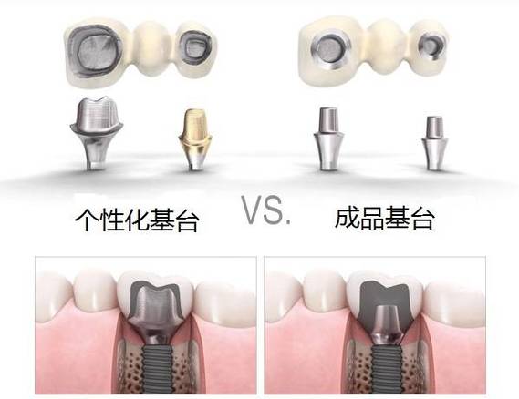 杭州缺牙后选进口还是国产种植体？到底哪个更划算？