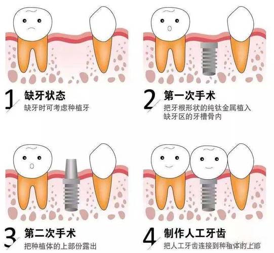进口与国产种植体哪个性价比高_国产种植体排名及价格_国产种植体质量如何
