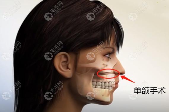 杭州深圳成人骨性龅牙矫正到底要花多少钱？