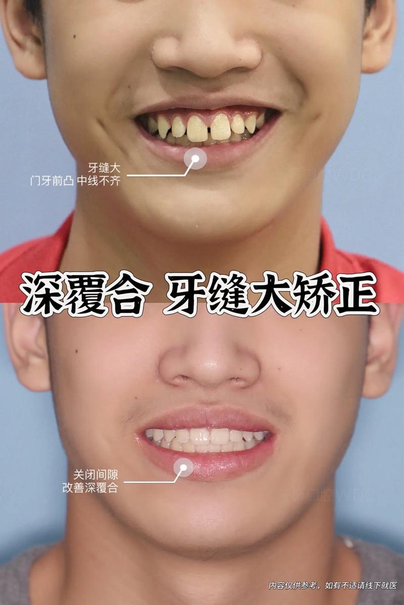 正畸的覆合覆盖标准_矫正覆合牙套多少钱_45岁矫正深覆合牙齿要多少钱