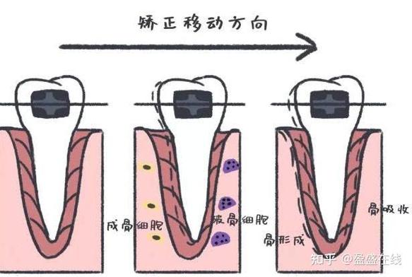 杭州23岁做牙齿矫正晚不晚？过来人分享真实经历