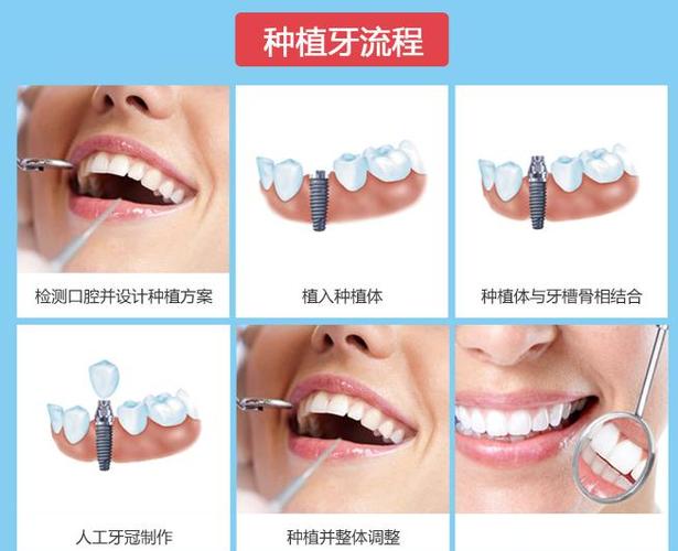 罗湖医院种一颗牙要多少钱_深圳罗湖骨量不足全口种牙费用_罗湖种牙哪里最好