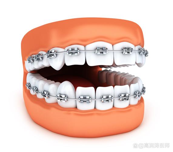 杭州成人牙齿外凸还能治好吗？正畸医生揭秘矫正真相与流程