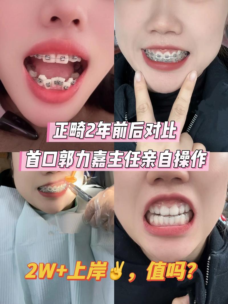 矫正覆合牙套多少钱_正畸的覆合覆盖标准_25岁牙齿深覆合可以矫正吗