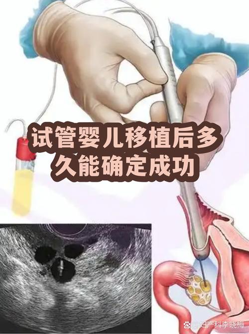 杭州一代试管婴儿能成功吗 看完心里有底