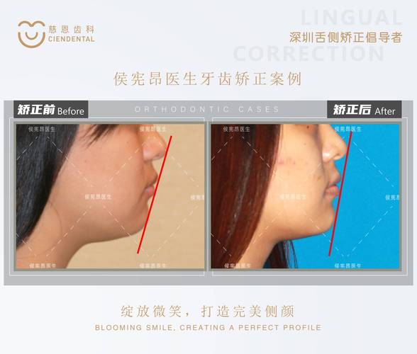 杭州为什么24岁做牙齿矫正效果更好