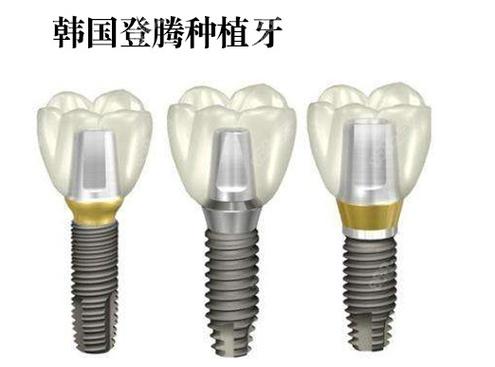 杭州株洲种牙哪家强？公立医院性价比之选