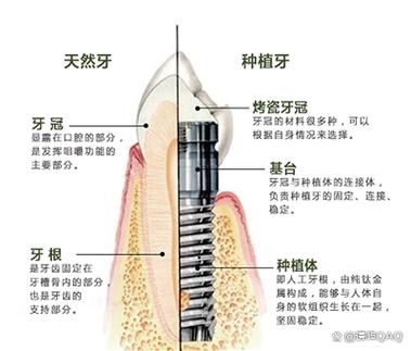 杭州深圳缺牙修复：镶牙与种植牙到底哪个更省钱？