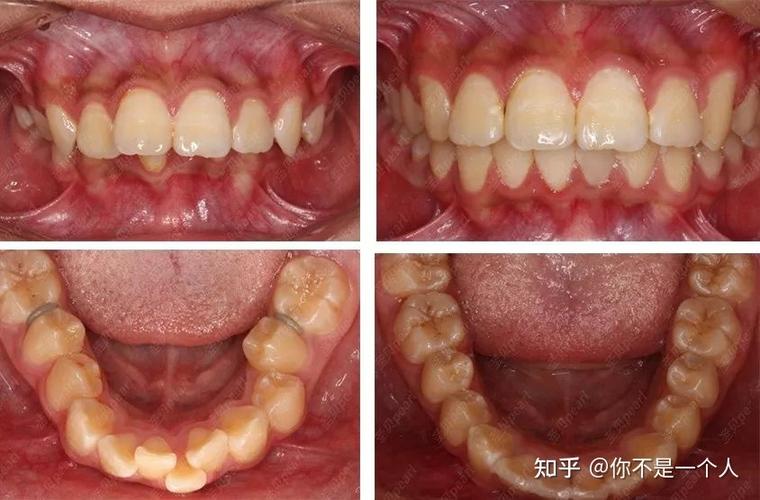 杭州27岁整牙晚不晚？揭秘成年正畸的真实效果与风险