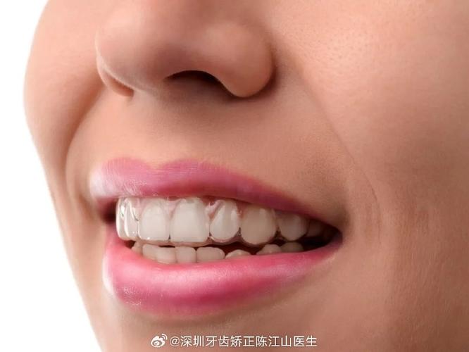 杭州成年人矫正牙齿多久能好？揭秘快速整牙的真相与代价