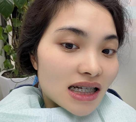 杭州30多岁还能整牙吗？医生：完全没问题，别被"年龄焦虑"忽悠了