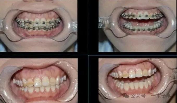 杭州30岁矫正牙齿有什么危害？把坑说透了再决定