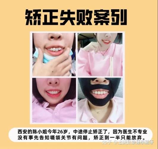 杭州28岁矫正牙齿还来得及吗？我的经历和答案