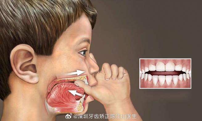 杭州深圳孩子地包天几岁治最好？牙医揭秘黄金期