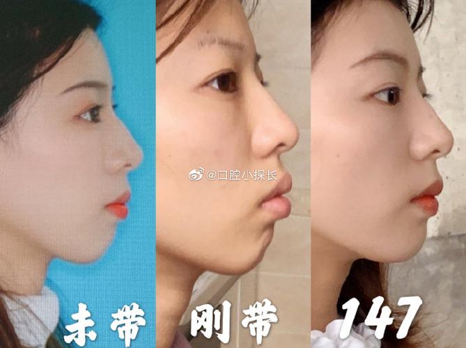 鄂尔多斯牙齿矫正贵吗_鄂尔多斯种植牙_鄂尔多斯牙齿矫正哪个医院好