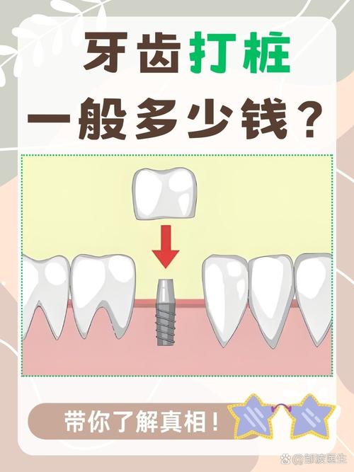 杭州打桩做牙和种植牙哪个好 30年牙医讲透区别