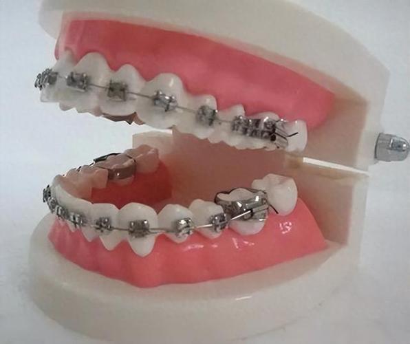 杭州35岁矫正牙齿还来得及吗？真实体验告诉你