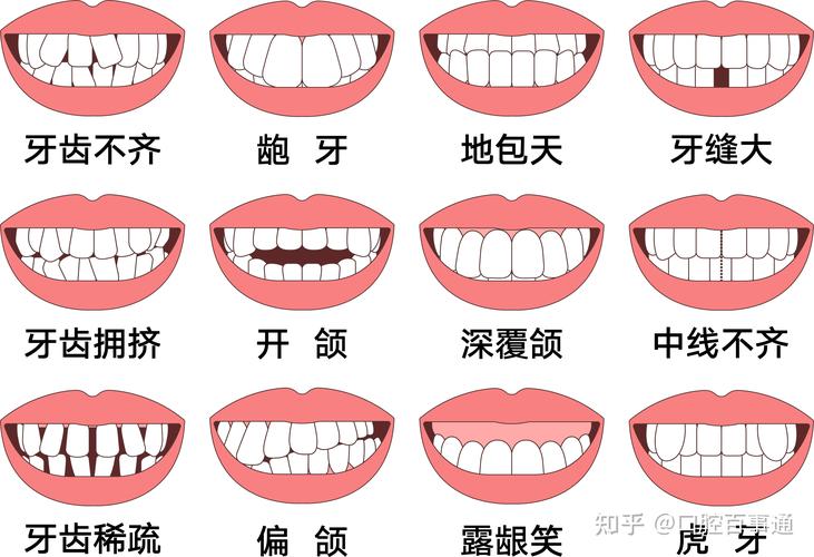 杭州25岁矫正牙齿还来得及吗真实经历分享