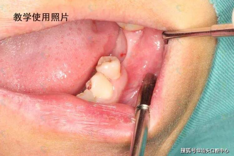 杭州没有牙骨也能种牙？医生说实话