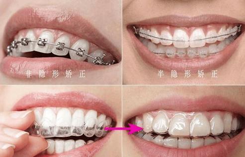 杭州25岁还能矫正牙齿吗？看完这篇不再纠结