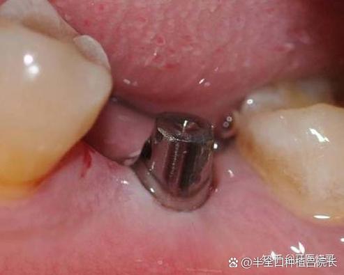 杭州深圳高血压糖尿病人能种牙吗？医生实话：控好指标就能种