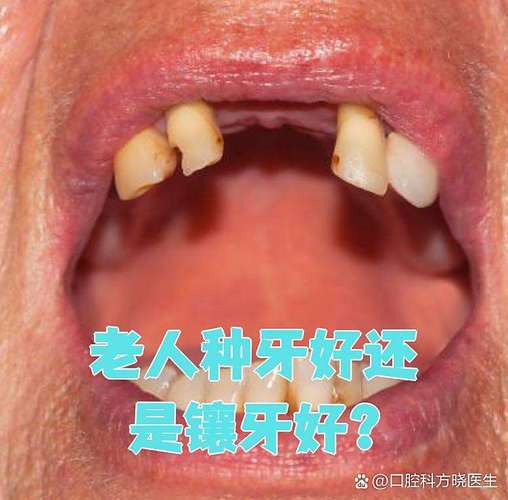 杭州74岁老人种牙晚不晚？医生揭秘高龄种植的真实风险与收益