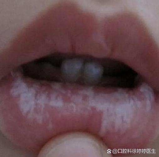 杭州儿童口腔有白色黏膜到底严不严重