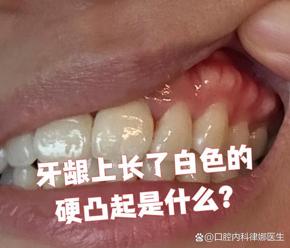 缺一颗牙一定要种吗_牙齿缺失种牙多少钱_缺牙不种牙