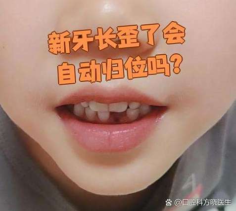 杭州六岁孩子门牙长歪先别慌 看这几种矫正办法