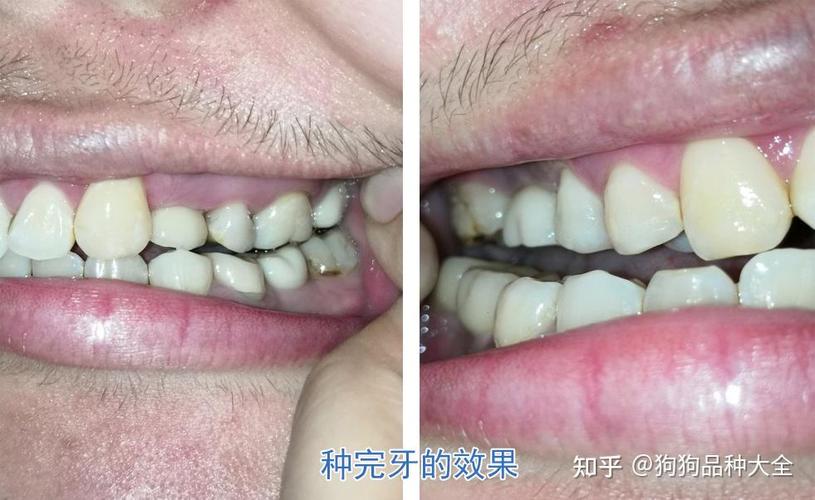 杭州赤峰种植牙哪里好 公立三甲靠谱推荐