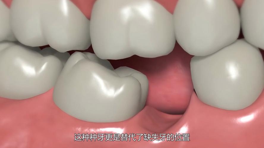 杭州种牙到底疼不疼?一篇说清楚植牙真相