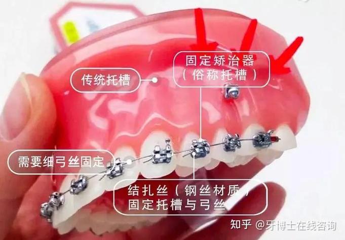 杭州深圳龙岗做隐适美矫正到底要花多少钱？