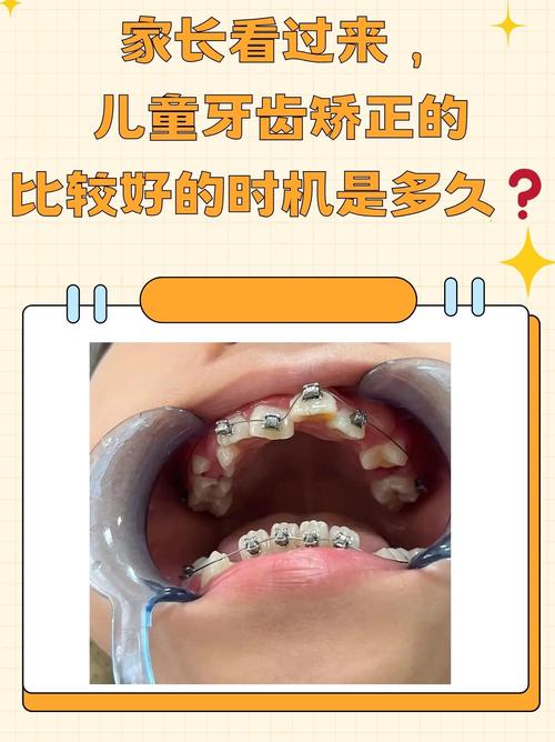 杭州8岁做牙齿矫正早不早？看情况，地包天要趁早
