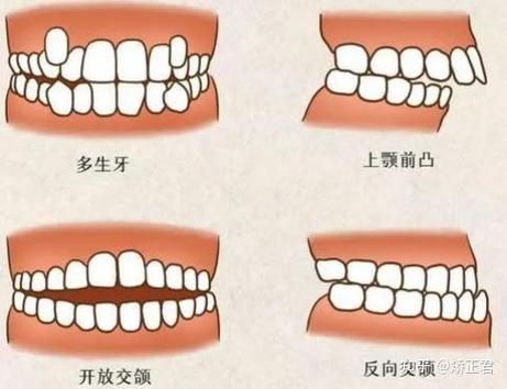 椒江隐适美牙齿矫正多少钱_隐适美矫正公司_隐适美矫正价格2万五