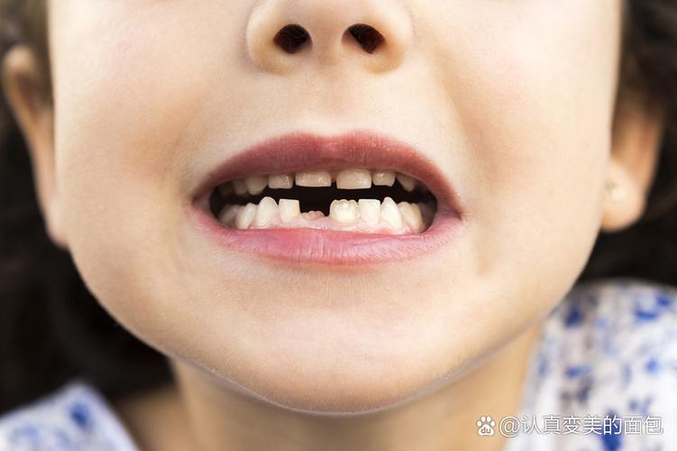 杭州8岁孩子牙齿矫正哪种方法好