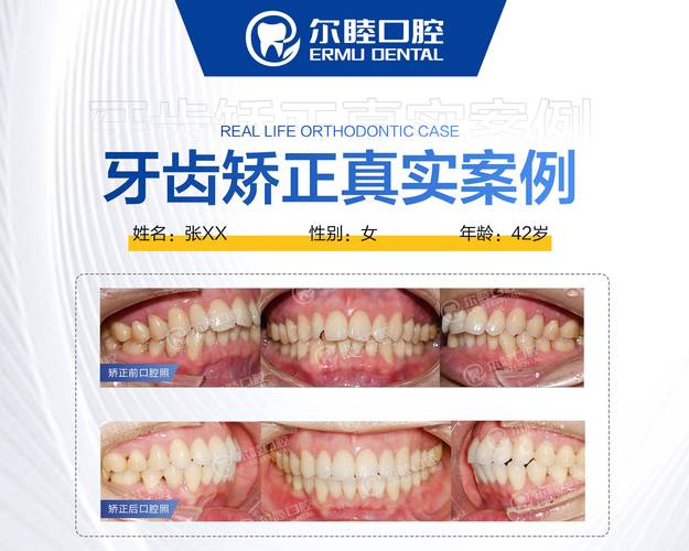 杭州深圳三十岁正畸多少钱 最新收费标准一览