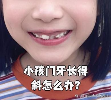 杭州深圳孩子换牙门牙乱长怎么办?专业干预攻略