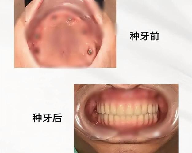 杭州70多岁还能种牙吗?种牙风险大不大?