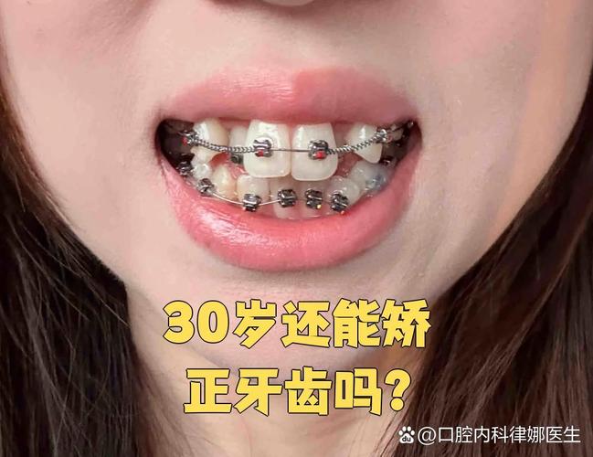 杭州30岁龅牙怎么快速矫正?