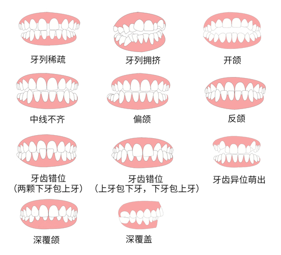 杭州30岁做牙齿矫正到底值不值 利与弊全分析