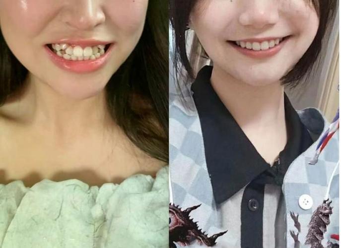 杭州36岁还能矫正牙齿吗 成人正畸的真相与风险