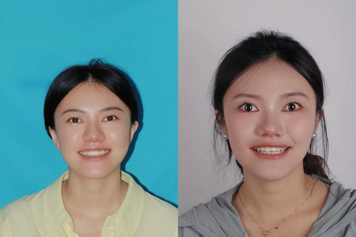 杭州20岁矫正牙齿晚不晚?过来人告诉你真实答案