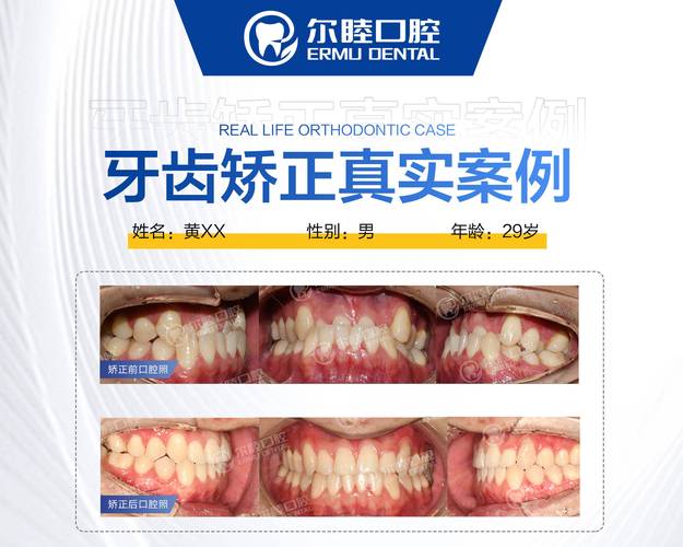 杭州深圳南山做MRC矫正哪家医院靠谱?