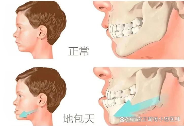 杭州12岁小孩能做牙齿矫正吗？别等换完牙才后悔