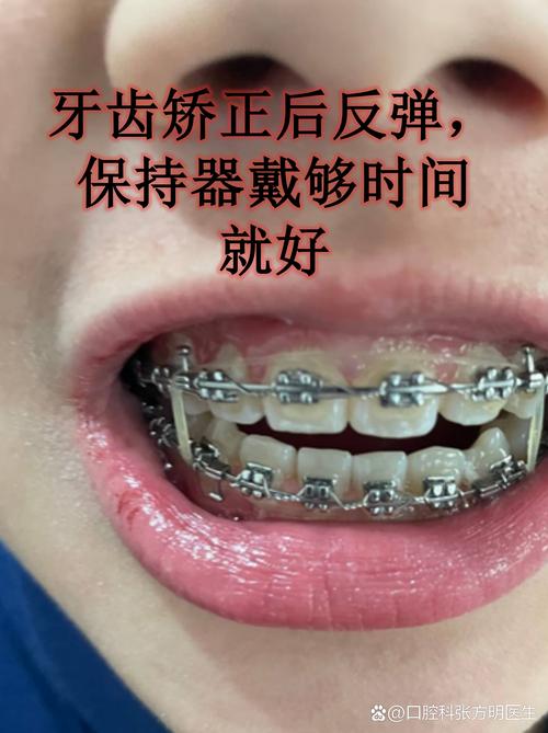 杭州6d牙齿矫正器有用吗?牙医揭秘:美容陷阱,小心伤牙