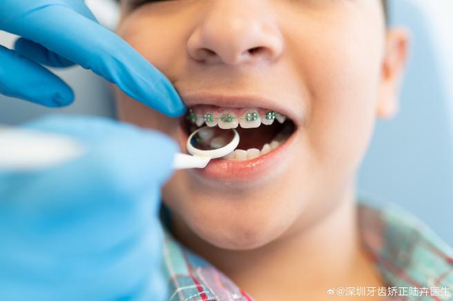 杭州8岁孩子门牙龅牙矫正方法 儿童早期干预怎么做