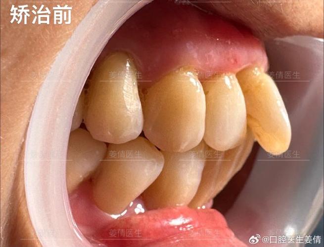 杭州60岁还能做牙齿矫正吗