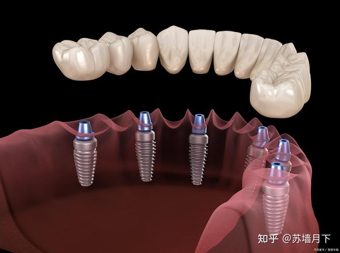 杭州深圳福田种一颗牙要多少钱?价格剖析