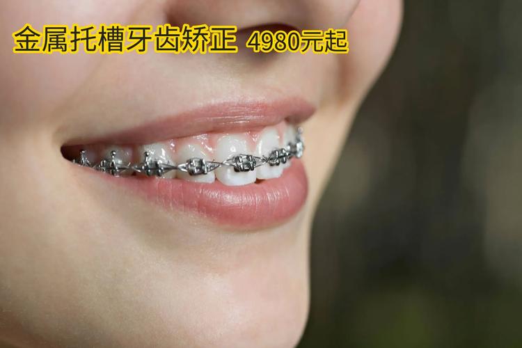 杭州珠海做牙齿矫正，不同牙套要花多少钱？