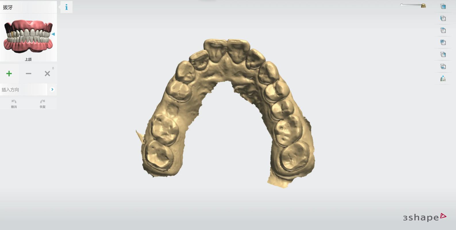 杭州3D导板数字化种植牙：告别传统盲种，种牙更精准更安心